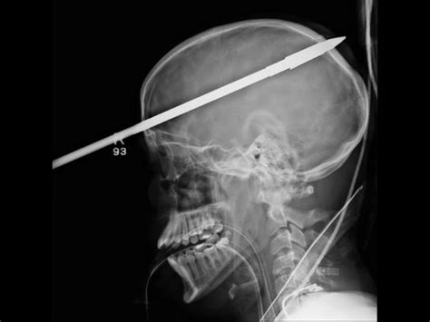 Swallowed Razor Blade Shocking Medical Scans Pictures Cbs News