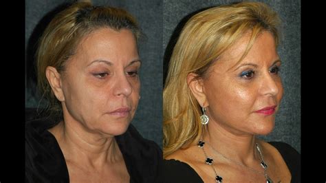 Smas Facelift Before And After 59 Year Old Woman Dr Jacono Reviews