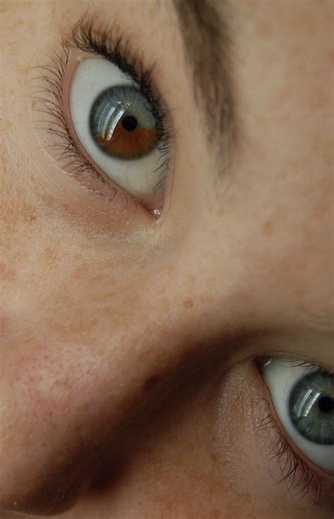 Sectoral Heterochromia Beautiful Eyes Color Rare Eye Colors