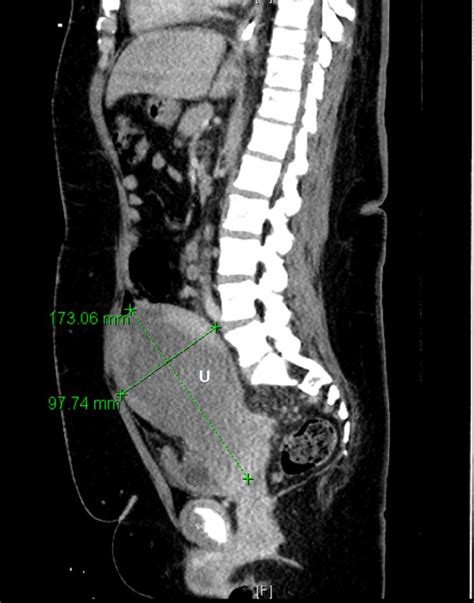Sagittal View Of CT Abdomen And Pelvis With Intravenous Contrast Download Scientific Diagram