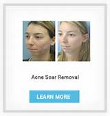Photos of Acne Scar Treatment Doctors