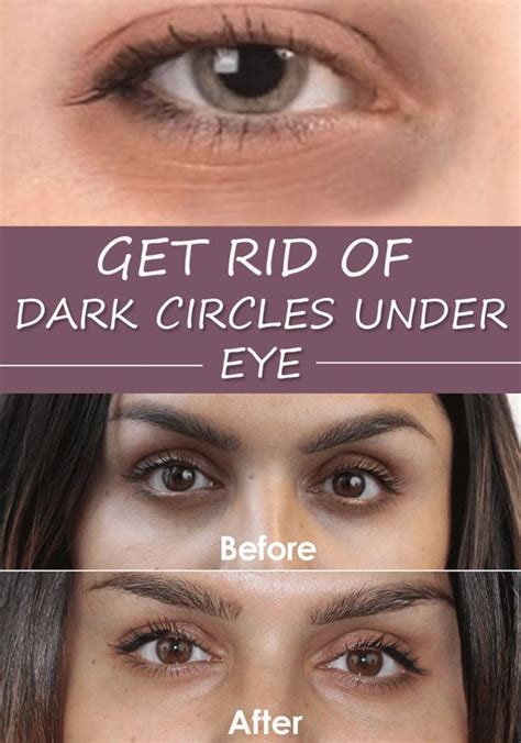Get Rid Of Dark Circles Under Eye Dark Circles Under Eyes Undereye