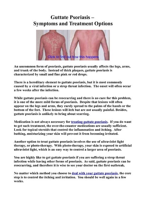 What Is The Best Treatment For Guttate Psoriasis