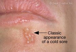 They're very common and, while uncomfortable, usually go away cold sores first form blisters on the lips, around the mouth, and sometimes inside the mouth. Cold Sores | Dear Doctor - Dentistry & Oral Health