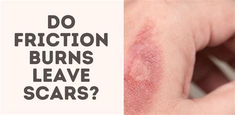 Do Friction Burns Leave Scars Treat Your Scars