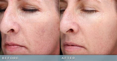 Skinpen Before And After Southeastern Dermatology