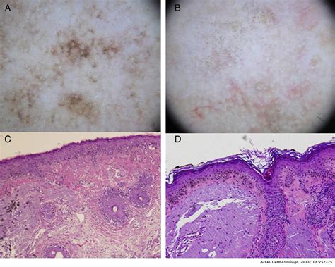 Lentigo Maligna Actas Dermo Sifiliográficas