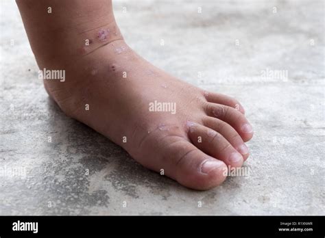 Itchy Dermatitis Atopic Baby Foot Close Up Infected Woundopened Wound