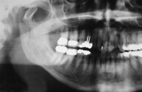 Mandibular Fractures Part 1 Intelligent Dental