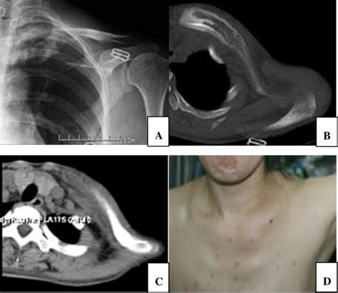 A 31 Years Female Patient With Bone Lymphoma Of Left Download Scientific Diagram