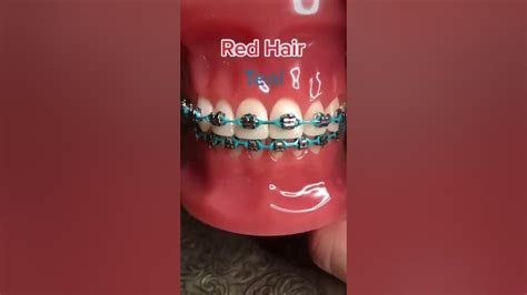 Best Braces Colors 🌈 Based On Your Hair Color Youtube