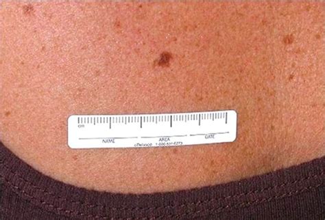 Mole Or Melanoma Test Yourself With These Suspicious Lesions