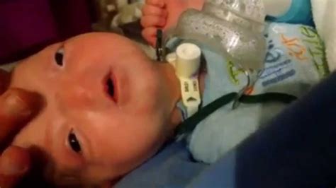 See Miracle Baby Born In Alabama With Rare Facial Anomaly Breathe And