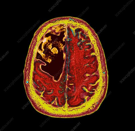 Glioblastoma Brain Cancer Ct Scan Stock Image C0509708 Science
