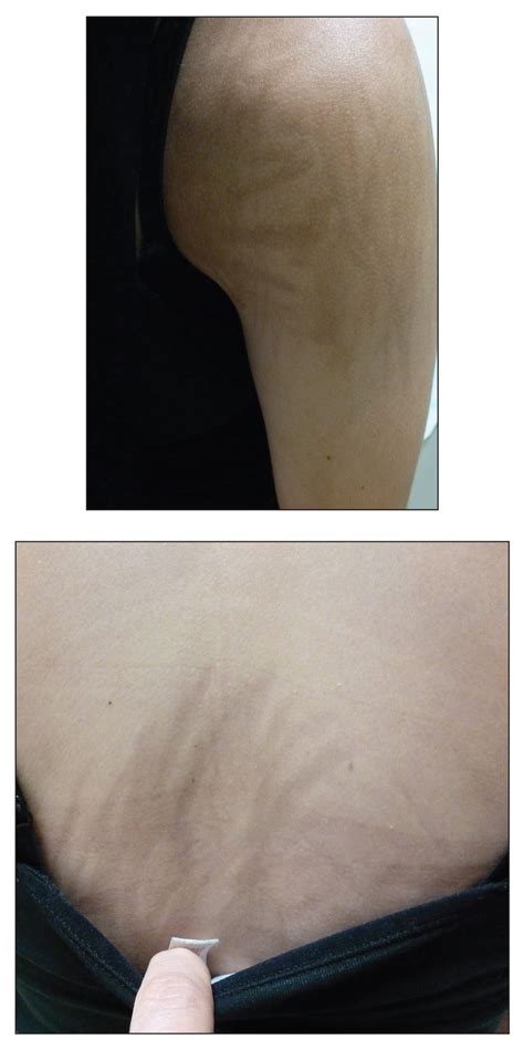 Streaked Discoloration On The Upper Body Mdedge Dermatology
