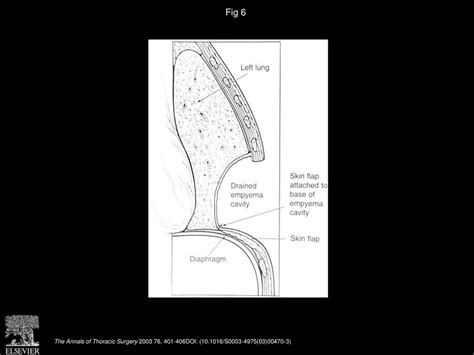 Twenty Six Years Of Experience With The Modified Eloesser Flap Ppt