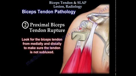 Biceps Tendon Slap Lesion Radiology Everything You Need To Know My