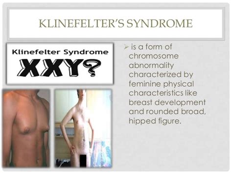 Pervasive Developmental Disorders Turner Syndrome Klinefelters Syn