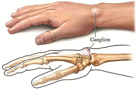 Personal Trainer Ganglion Cysts Health Nails Magazine