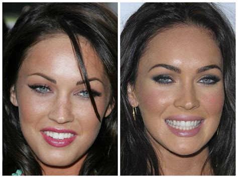 celebrity teeth veneers