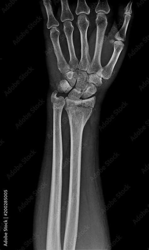 Wrist X Ray X Ray Show Distal Radius Fractures Broken Wrist Stock