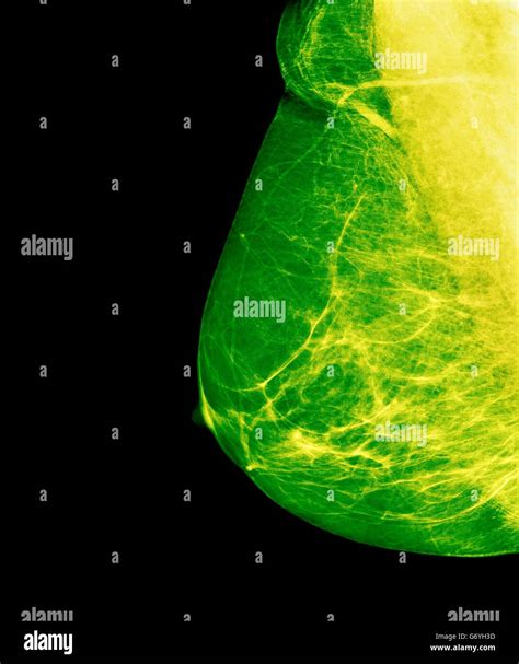 Breast Cancer Screening Coloured Breast X Ray Mammogram Performed