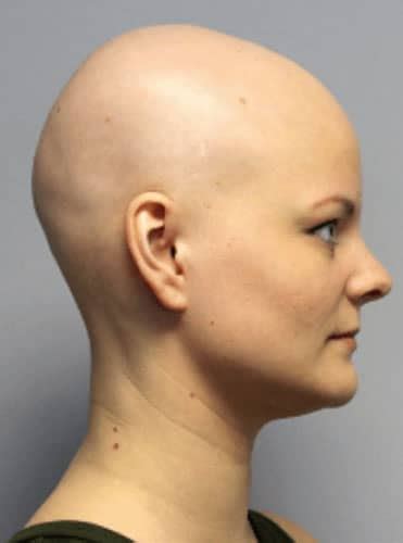 alopecia hair conditions uk hair consultants