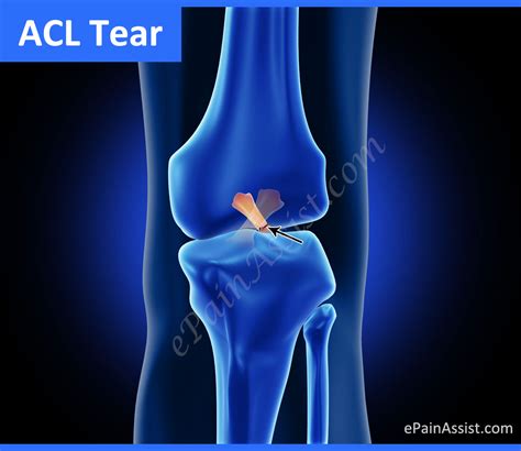 What Is An Acl Tear And What Are Its Signs And Symptoms