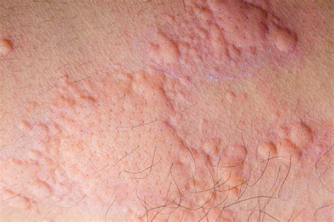 5 Ways Covid 19 Affects The Skin Allergykb