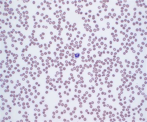 Cureus Cirrhosis With Splenomegaly And Pancytopenia Complicating A