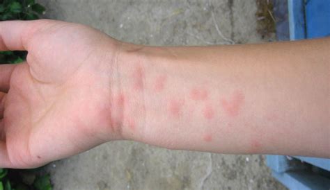 Raised red skin rash that itches and oozes, what is this? answered by dr. 6 rashes that can ruin your summer | Cottage Life