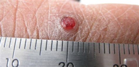 Heres What Your New “red Mole” Could Mean