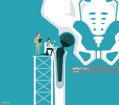 Structure Of The Artificial Hip Joint High Res Vector Graphic Getty