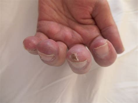 Rheumatologe Scleroderma Ulcers On Fingers