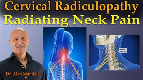 Cervical Radiculopathy Radiating Neck Pain Dr Mandell Live Stream