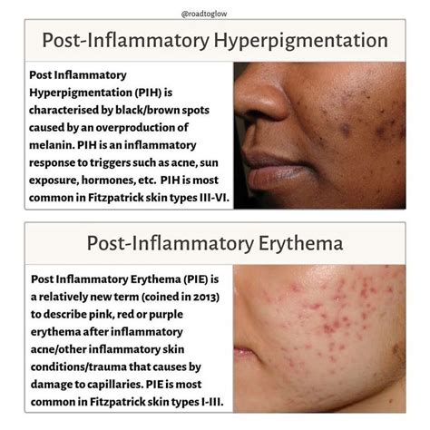 Roadtoglows Instagram Post “🔍 Post Inflammatory Hyperpigmentation Vs