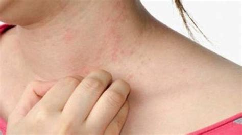Hives Symptoms Picture And Treatment Health Digest