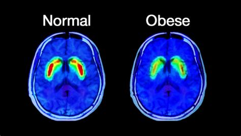 Obesity Brain Scan Mapping Ignorance