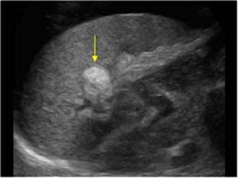 Wk 5 Spleen Pathology Hyperechoic Liver Splenic Peritoneal And