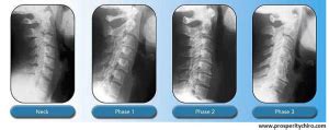 Thoracic spondylosis frequently does not cause symptoms. Cervical Spondylosis - ZYEX Physiotherapy & Rehabilitation ...
