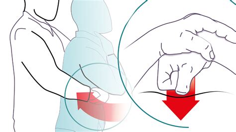 Maniobra De Heimlich Si El Paciente Est Consciente Tenemos Tiempo Lo M S Importante Es No