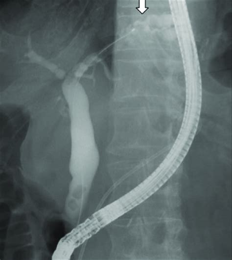 Endoscopic Retrograde Cholangio Pancreatography Ercp Showing Several