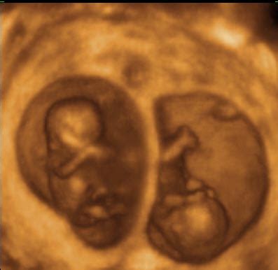 Ultrasound 12 weeks twin 4D Twins