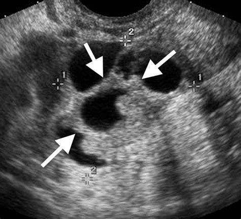 Adnexal Masses US Characterization And Reporting Radiology