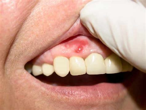 Severe Gum Pain All You Need To Do For Better Relief