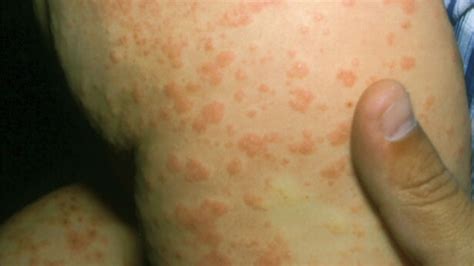 What Is Acrodermatitis Causes Symptoms And More