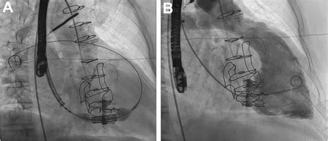 Transcatheter Tricuspid Valve Replacement For Surgical Failures