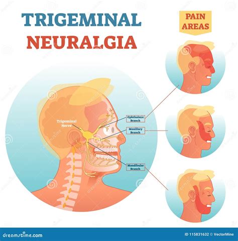 Trigeminal Neuralgia Medical Cross Section Anatomy Vector Illustration