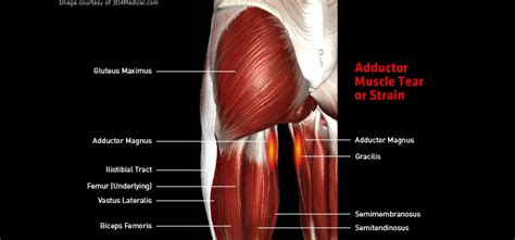 Patellar tendonitis is a common injury or inflammation of the tendon that connects your kneecap (patella) to your shinbone (tibia). Adductor Muscle Tear or Strain - Thermoskin - Supports and ...
