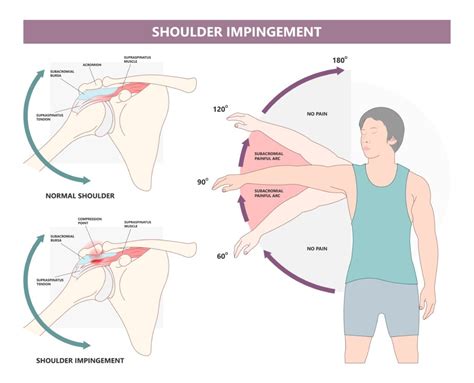 Shoulder Impingement Exercises Best Advice In
